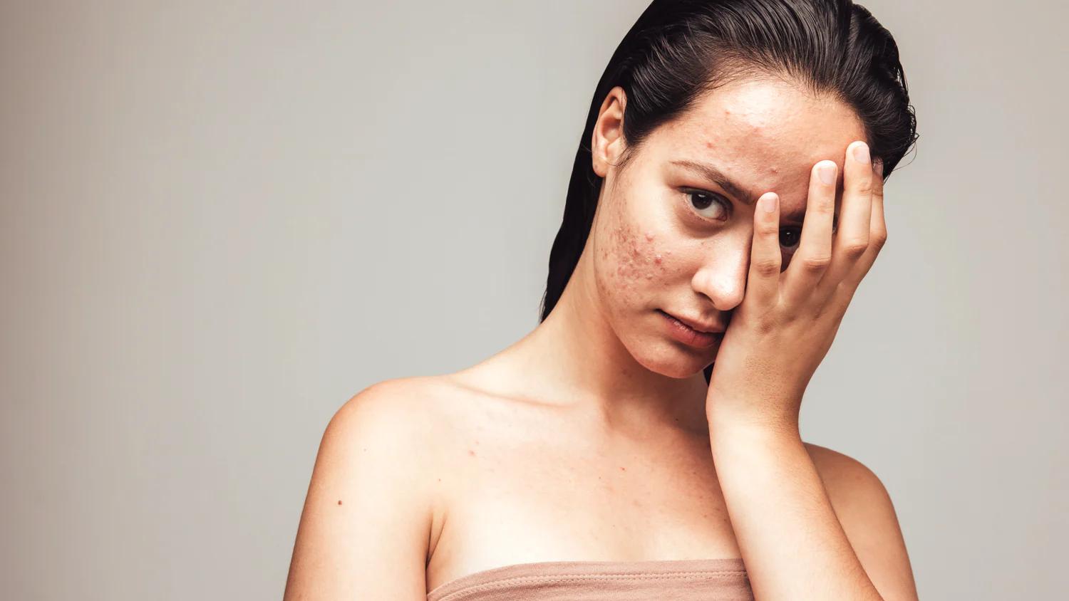 The Link Between Diet, Stress, and Acne: What Dermatologists Recommend