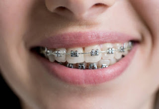 Smile Evolution: Why Braces in Traverse City MI Are Still the Smart Choice