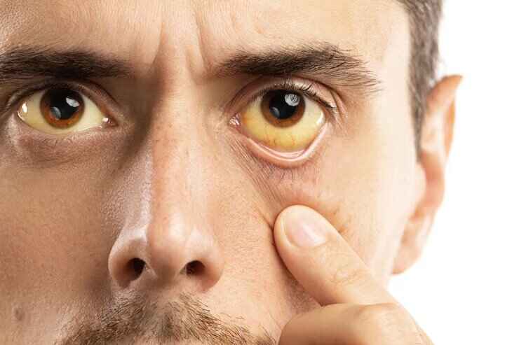World Hepatitis Day 2026: Breaking Down Barriers to Eliminate a Silent Killer - doctorspot.in